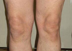 Nach einer Kur mit Osteflex sind die Gelenke wieder normal