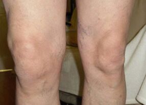Vor der Anwendung von Osteflex waren Nils‘ Knie am Ende des Tages geschwollen.
